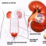 Causes, symptoms and treatment of urolithiasis in men First aid for urolithiasis in men